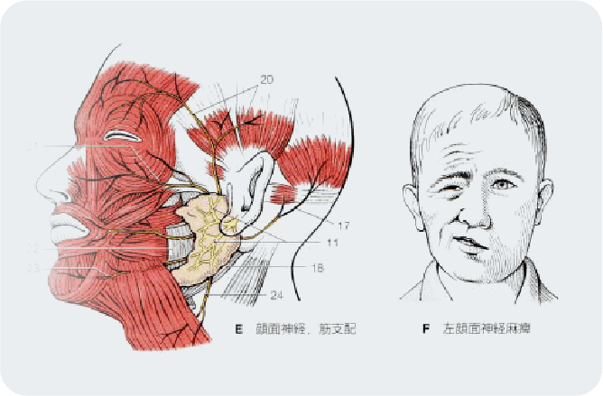 顔面神経麻痺